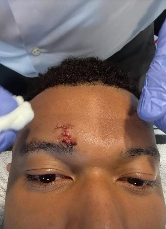 姆巴佩面部缝针伤情曝光 欧冠次回合迎战拜仁